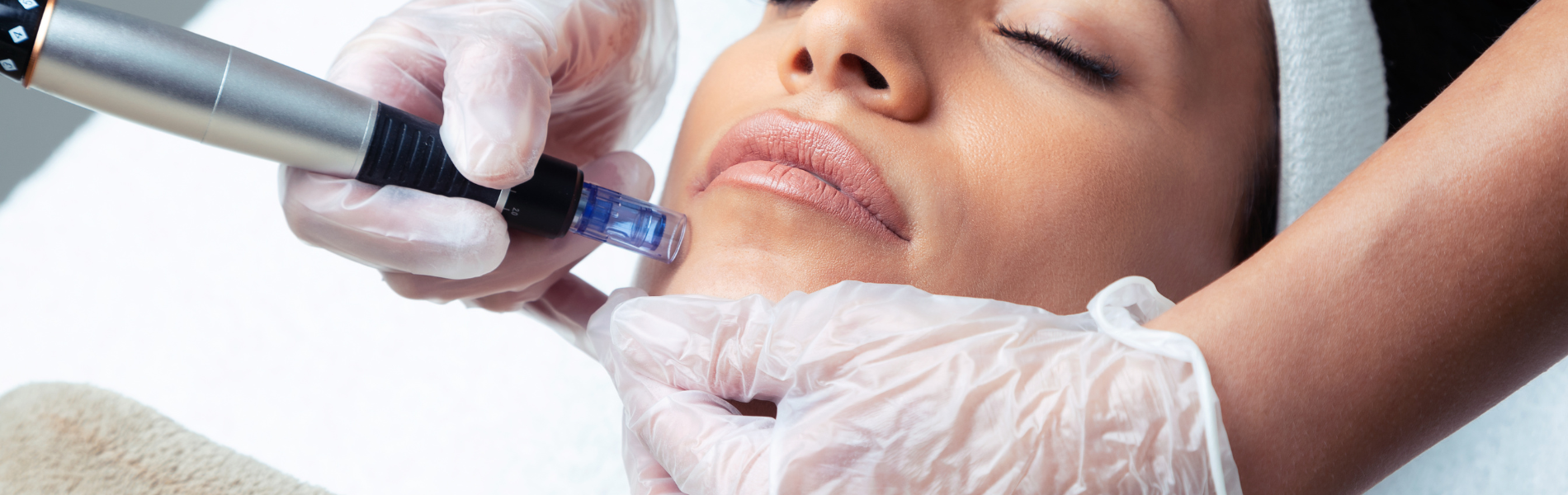 Advanced Aesthetics Microneedling